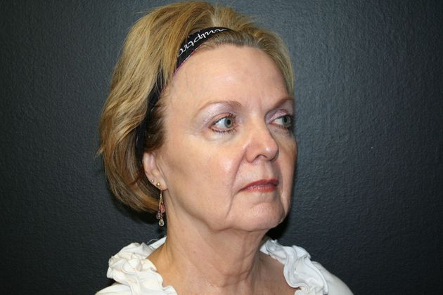 Facelift Case 3 - Before
