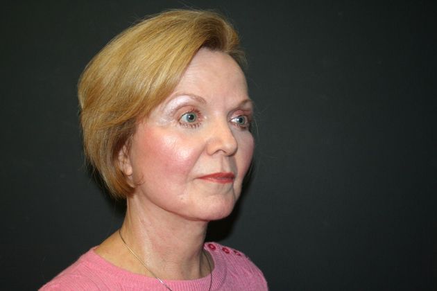 Facelift Case 3 - After