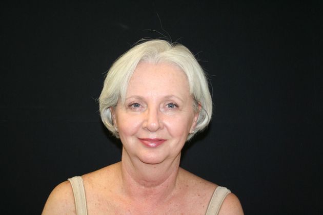 Facelift Case 4 - Before