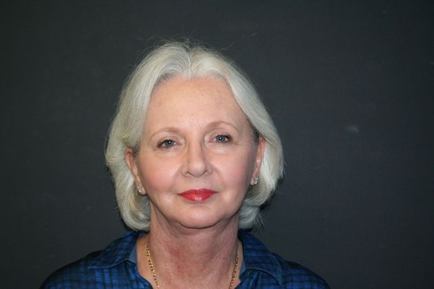 Facelift Case 4 - After