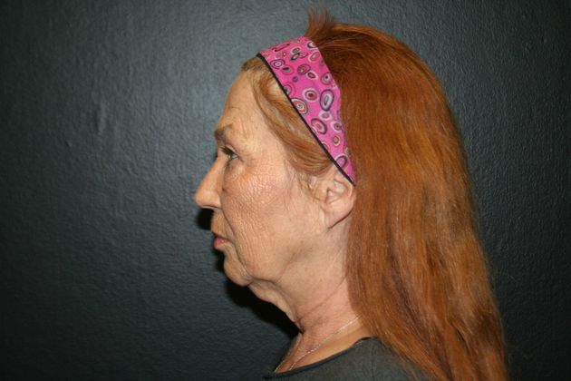 Facelift Case 5 - Before