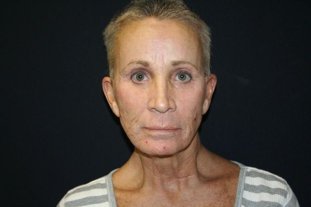 Facelift Case 6 - Before