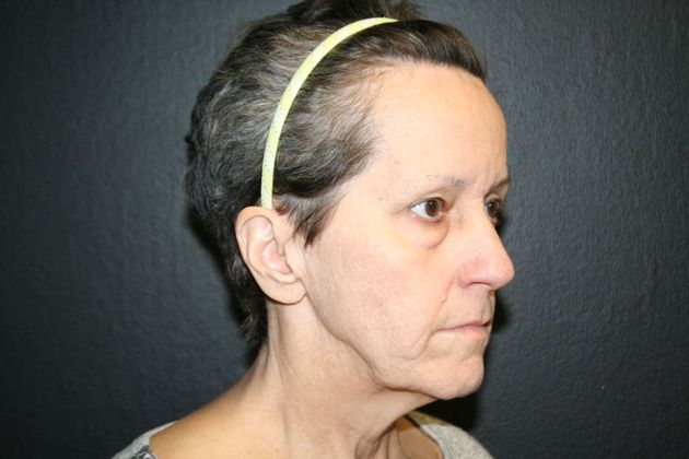 Facelift Case 7 - Before