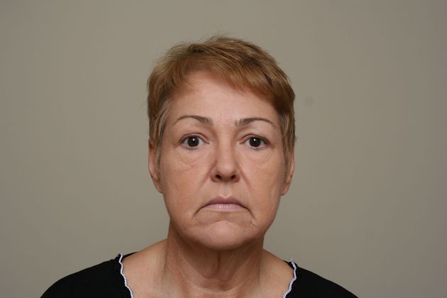 Facelift Case 8 - Before