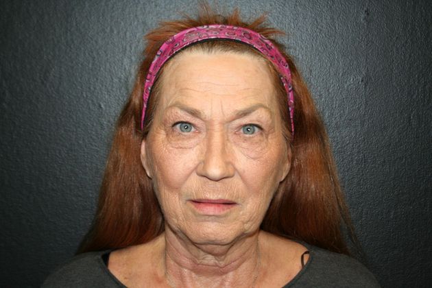 Facelift Case 9 - Before