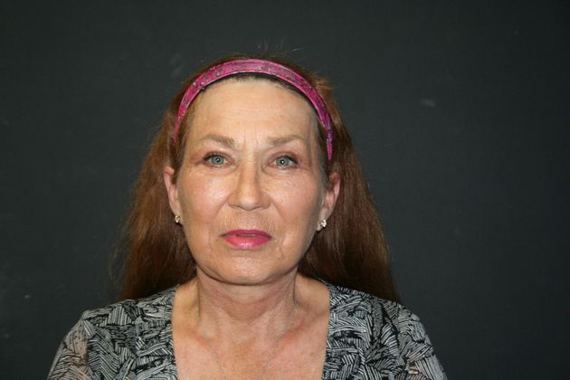 Facelift Case 9 - After