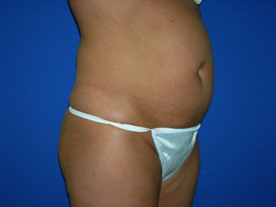 Abdominoplasty Case 1 - Before