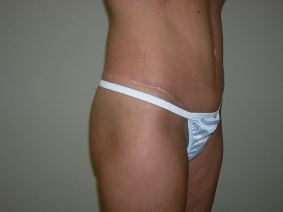 Abdominoplasty Case 1 - After