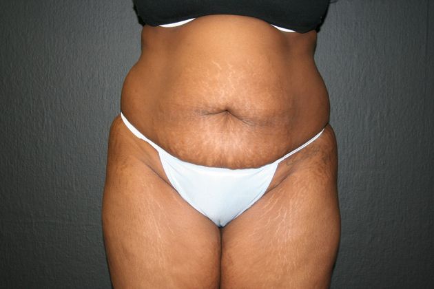 Abdominoplasty Case 2 - Before