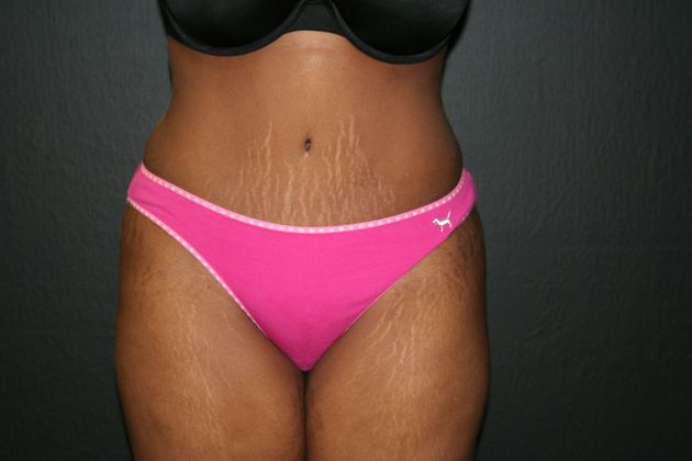Abdominoplasty Case 2 - After