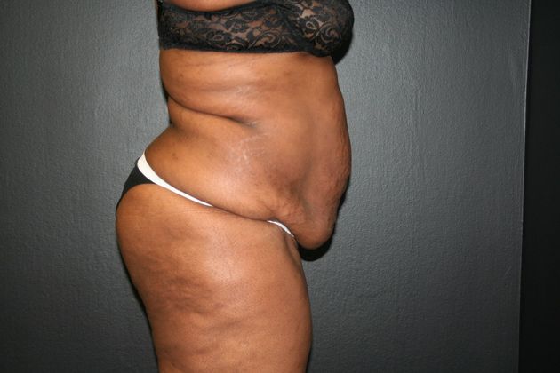 Abdominoplasty Case 4 - Before
