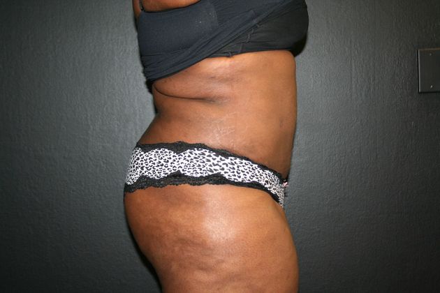 Abdominoplasty Case 4 - After