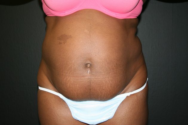 Abdominoplasty Case 5 - Before