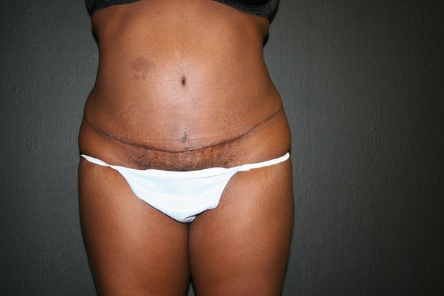 Abdominoplasty Case 5 - After