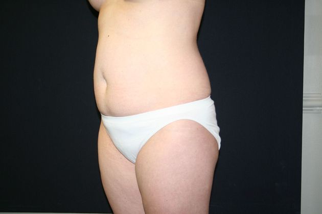 Abdominoplasty Case 6 - Before