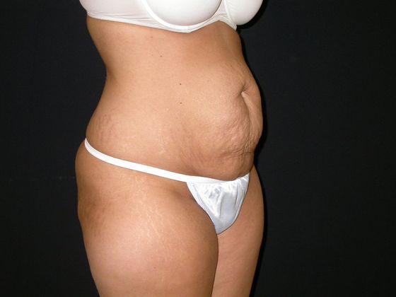 Abdominoplasty Case 7 - Before