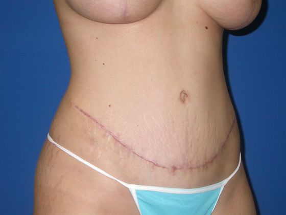 Abdominoplasty Case 7 - After