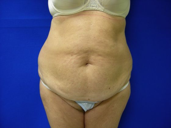 Abdominoplasty Case 8 - Before