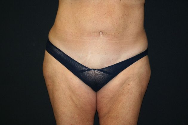 Abdominoplasty Case 8 - After