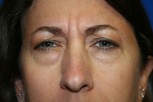Blepharoplasty: Case 1 - Before 