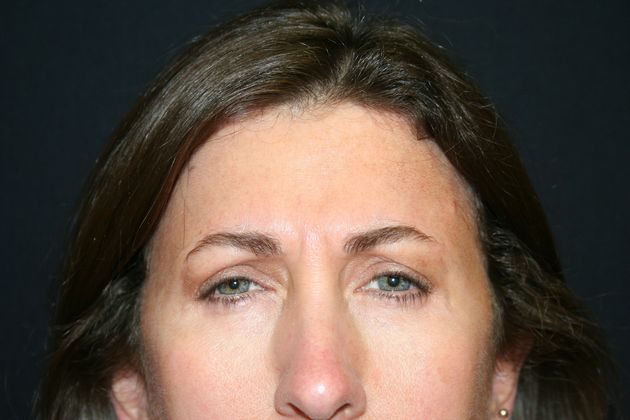 Blepharoplasty: Case 1 - After 
