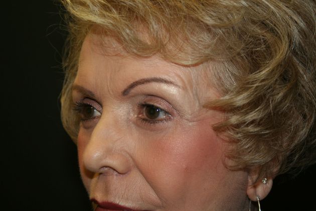 Blepharoplasty: Case 2 - After 