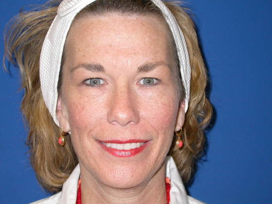 Blepharoplasty: Case 3 - Before 