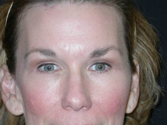 Blepharoplasty: Case 3 - After 
