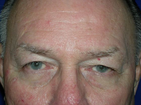 Blepharoplasty: Case 4 - Before 