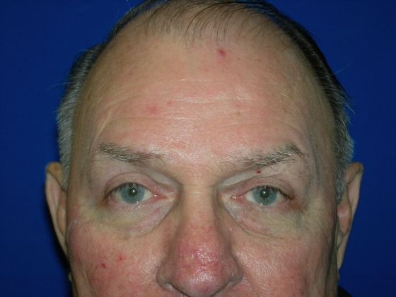 Blepharoplasty: Case 4 - After 