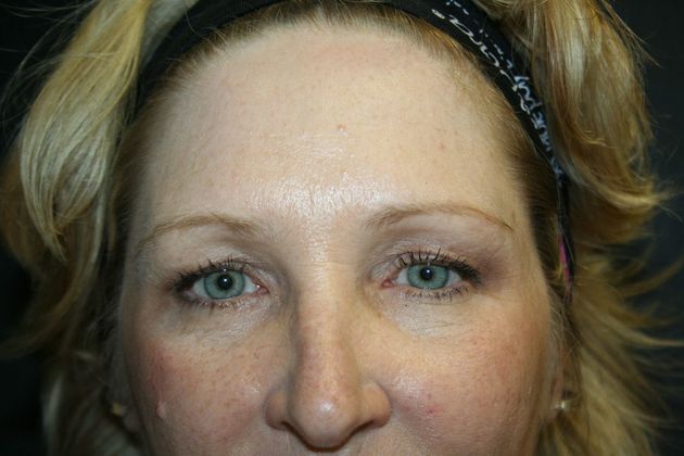 Blepharoplasty: Case 5 - Before 