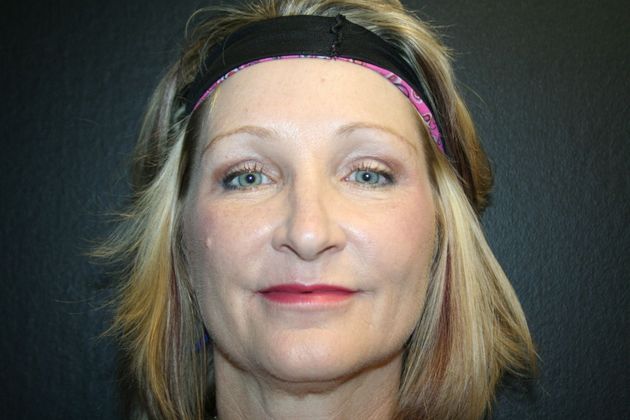 Blepharoplasty: Case 5 - After 