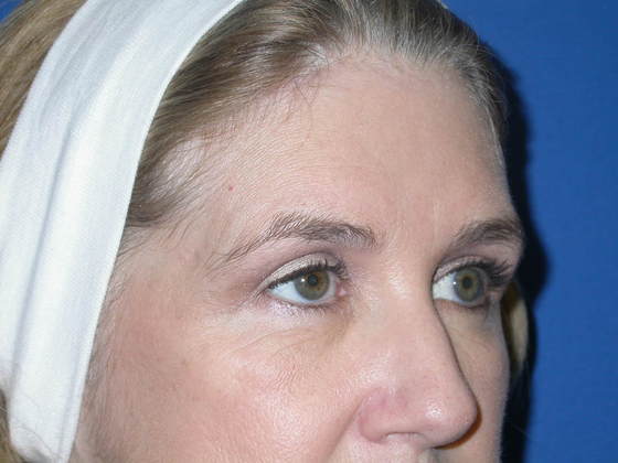 Blepharoplasty Case 6 - After