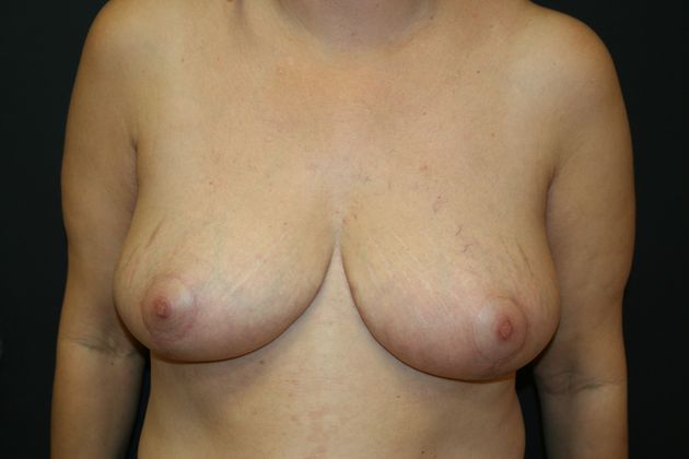 Breast Reduction Case 2 - After