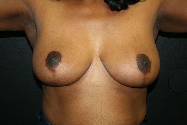 Breast Reduction Case 4 - After