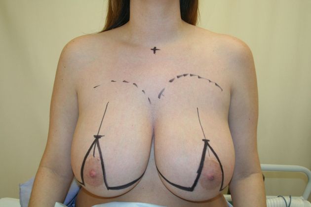 Mastopexy Case 5 - Before