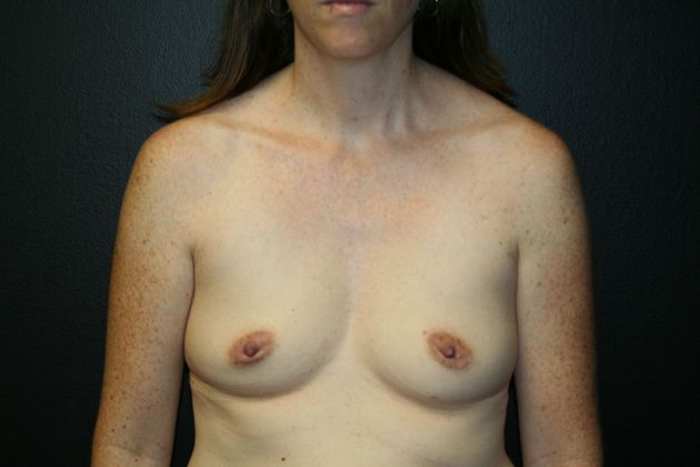 Breast Augmentation Case 9 - Before