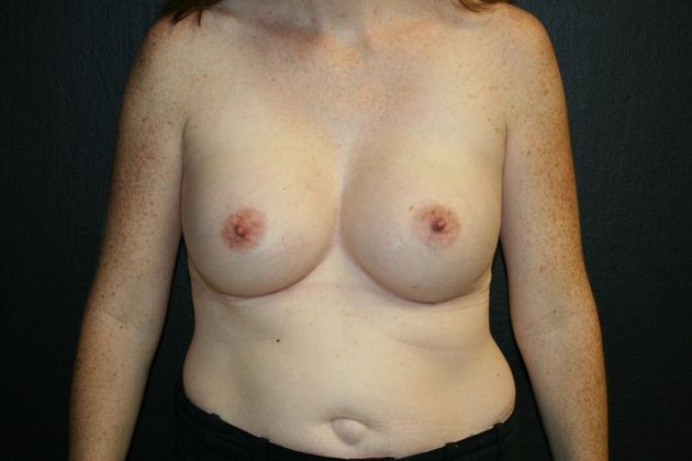 Breast Augmentation Case 9 - After