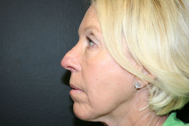 Chin Augmentation Case 1 - Before