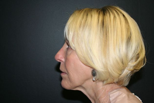 Chin Augmentation Case 1 - After