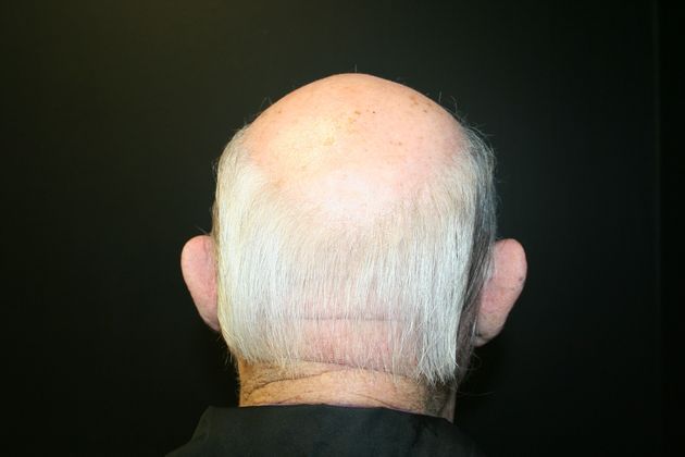 Otoplasty Case 1 - Before