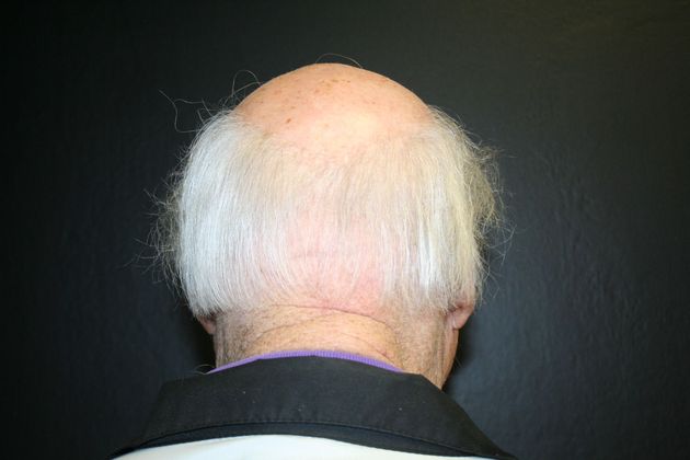 Otoplasty Case 1 - After