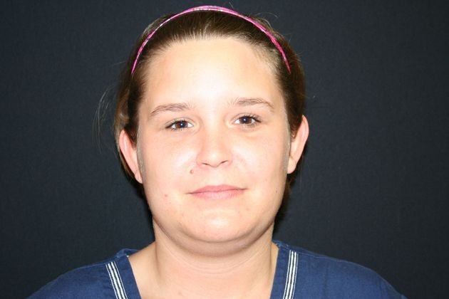 Otoplasty Case 2 - Before