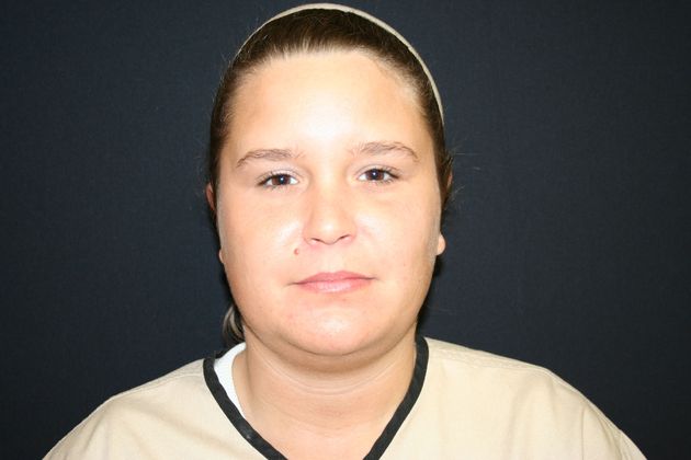 Otoplasty Case 2 - After