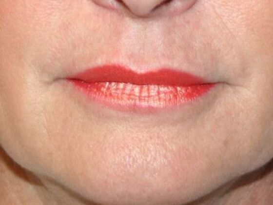 Cosmetic Injectables & Fillers Case 1 - Before