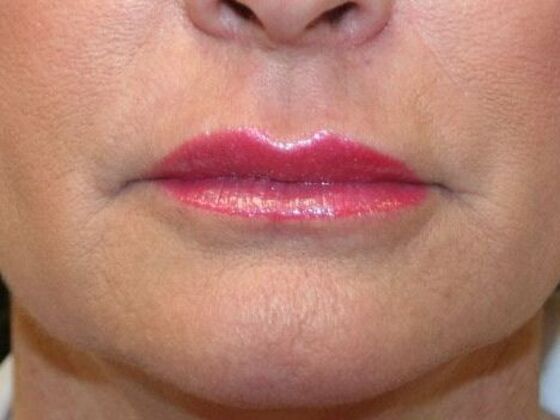 Cosmetic Injectables & Fillers Case 1 - After