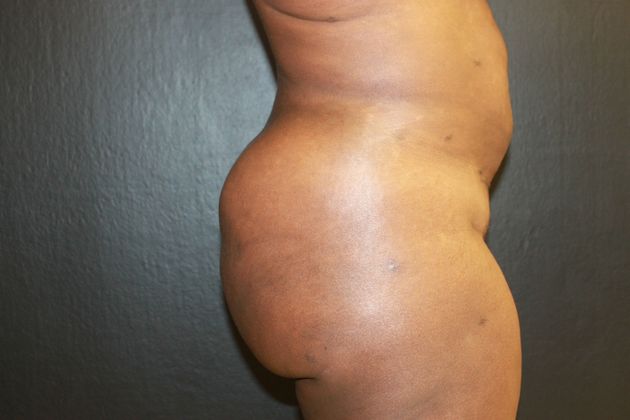 Brazilian Butt Lift: Case 1 - After