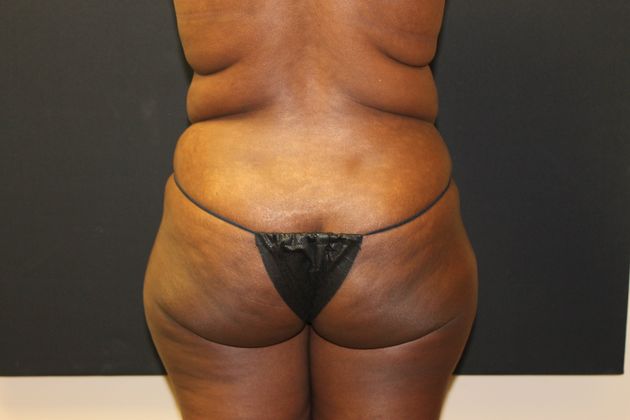 Brazilian Butt Lift: Case 2 - Before