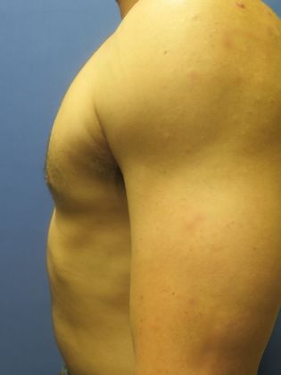 Gynecomastia Surgery (Male Breast Reduction Surgery): Case 2 - After