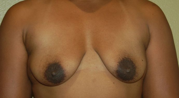 Breast Augmentation w/ Lift Case 167 - Before